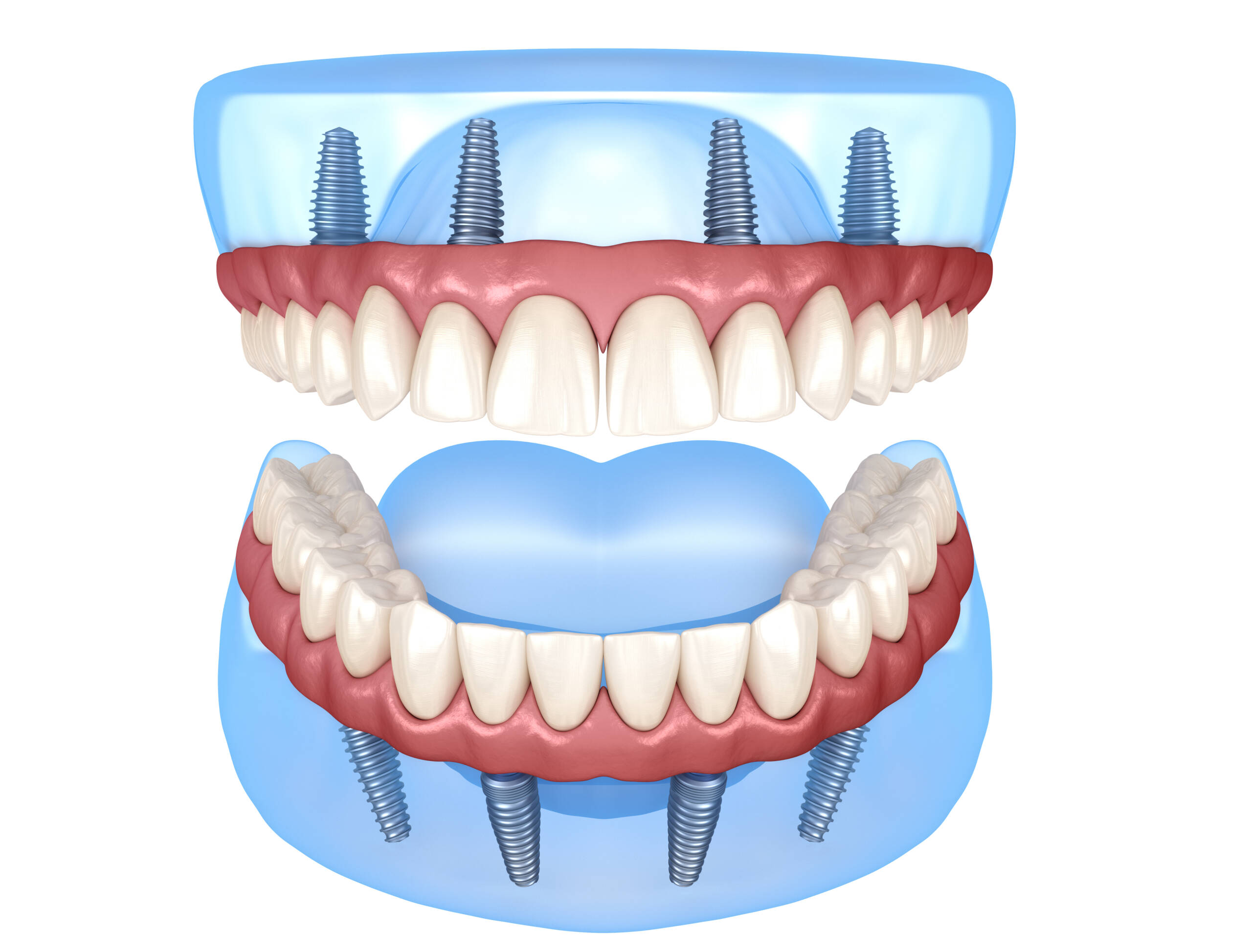 Full Mouth Reconstruction (All-on-4/All-on-6)