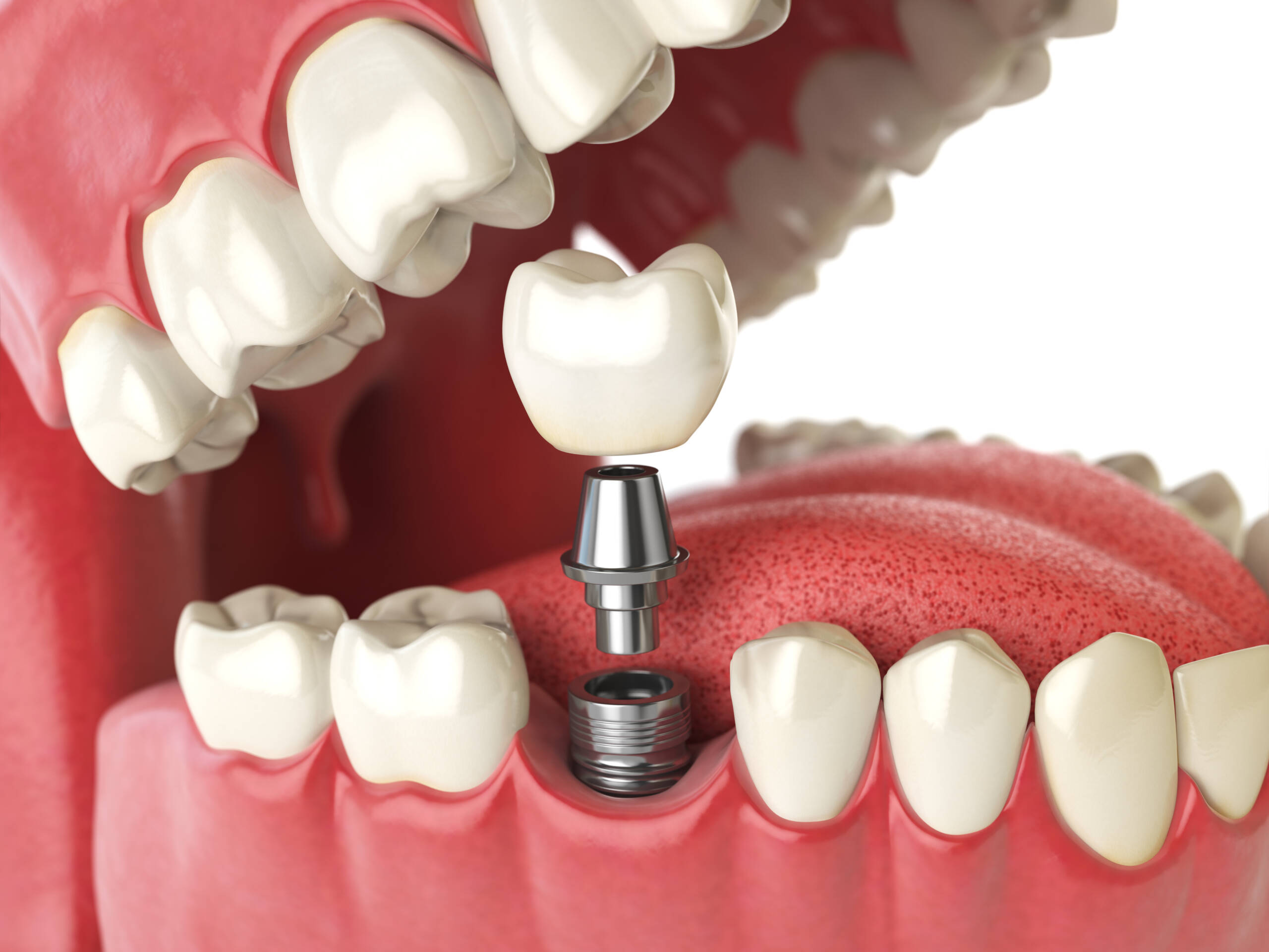 Same-Day Teeth Replacement