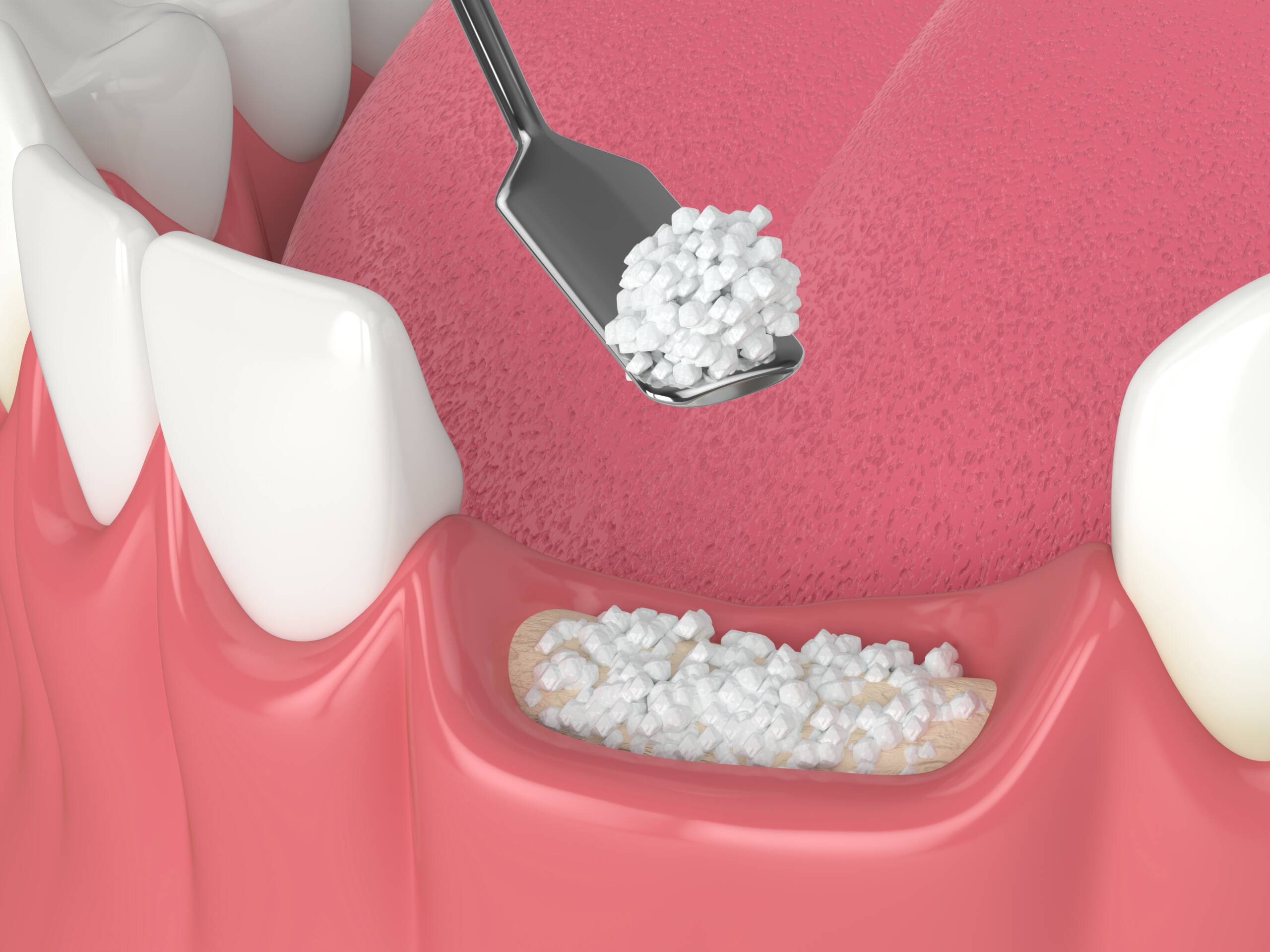 Advance Soft Tissue and Bone Grafting Techniques