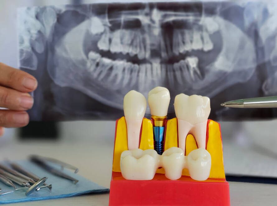 dental implants vs dentures