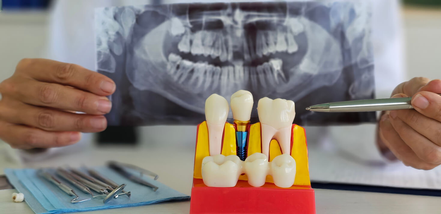 dental implants vs dentures