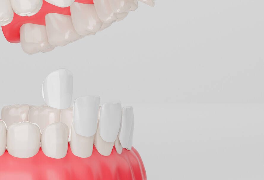 can veneers be removed