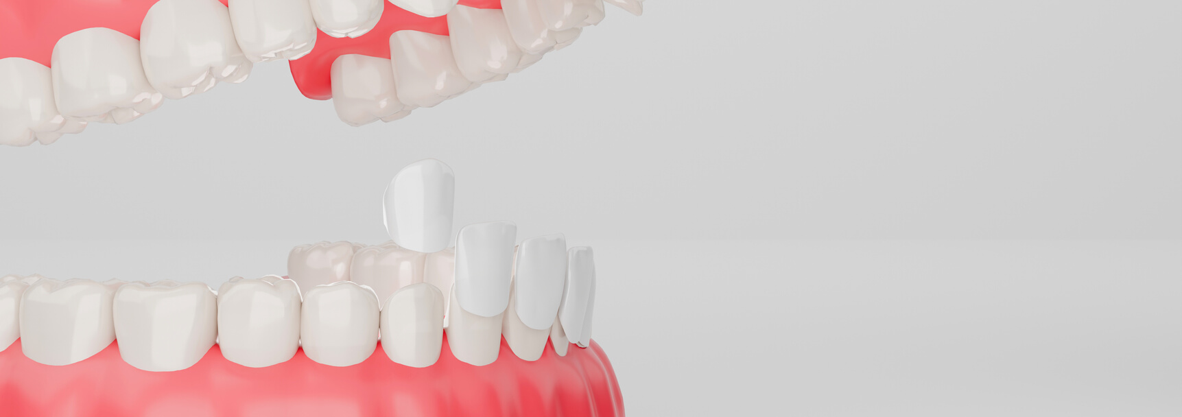 can veneers be removed