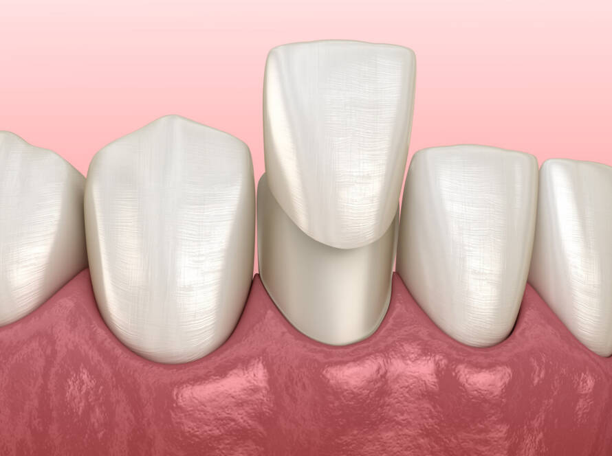 how long do composite veneers last