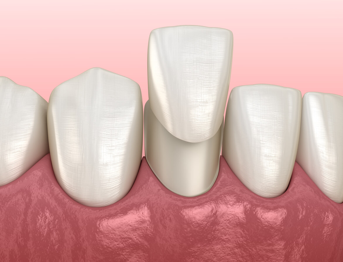 how long do composite veneers last