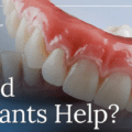 Thinking About Replacing a Missing Tooth? Read This First
