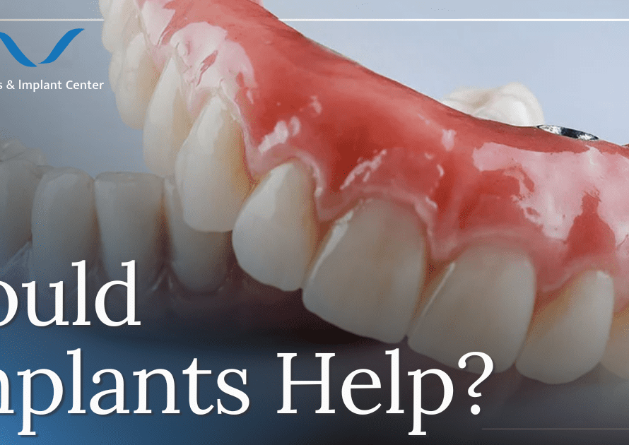 dental implants