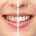How Long Does Teeth Whitening Last?