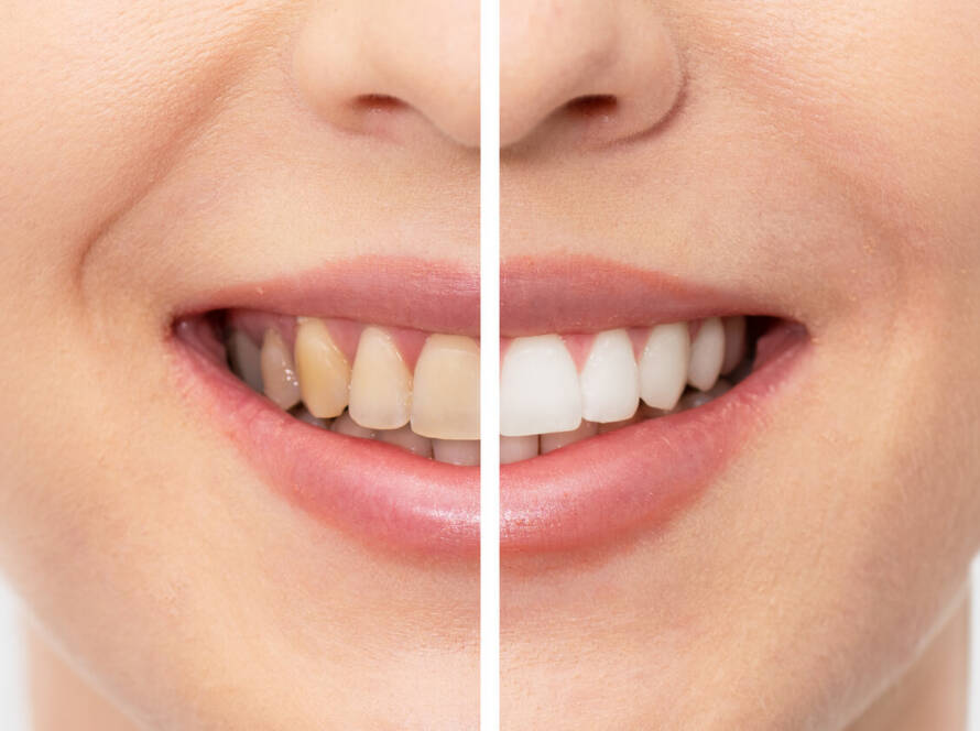 How Long Does Teeth Whitening Last