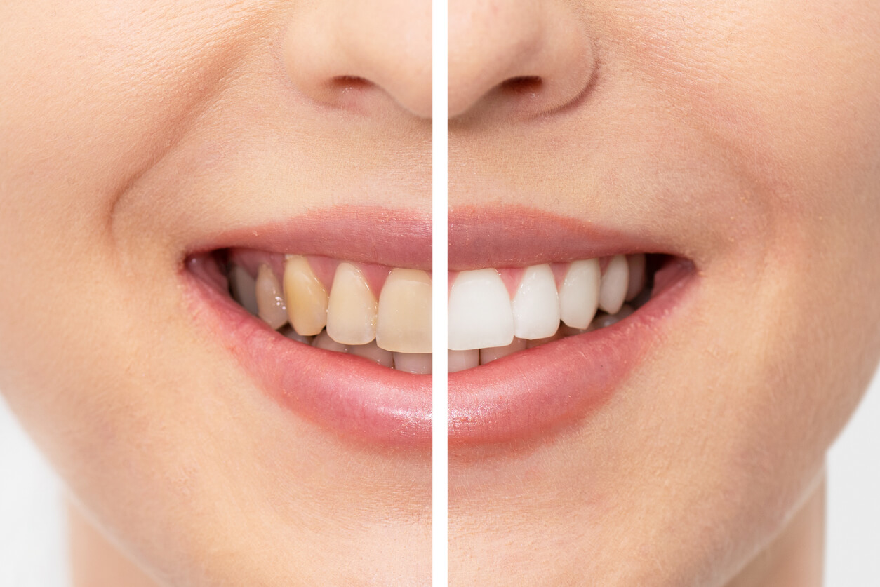 How Long Does Teeth Whitening Last