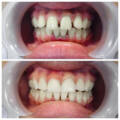 Dental Bonding vs Veneers: Which Option Makes More Sense for Your Smile?